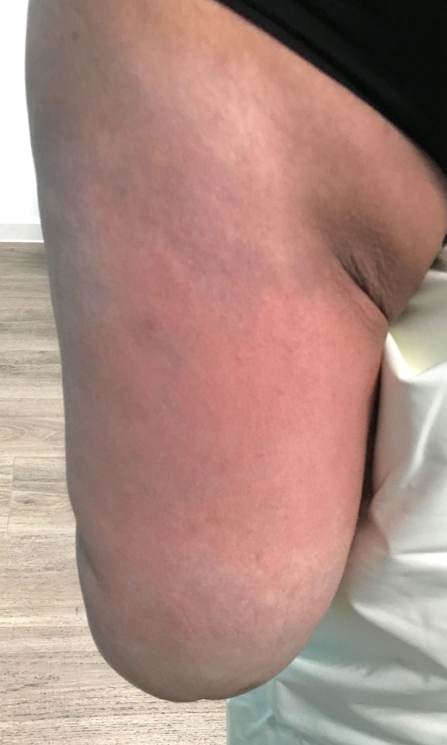 Adduttore sensibile — Arto