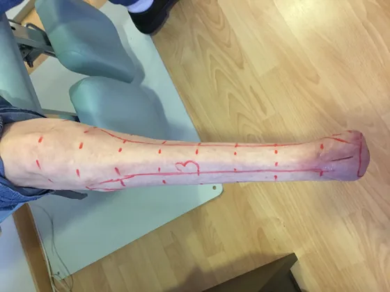 Long & Thin residual limb