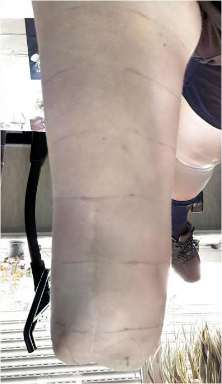Sensitive Condyles — Limb