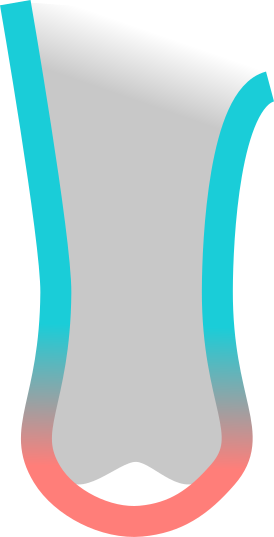 Standard liner over-stretched on condyles