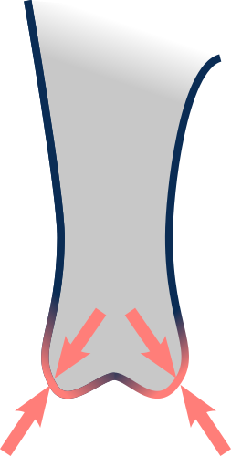 Poorly cushioned condyles
