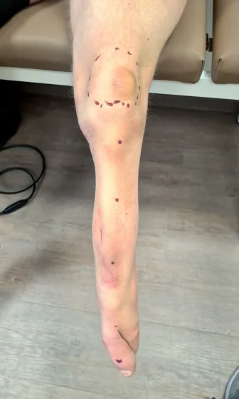 Congenital — Limb