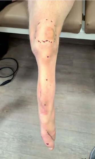 Congenital residual limb