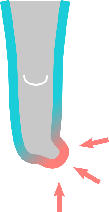 Standard liner overstretched on extremities