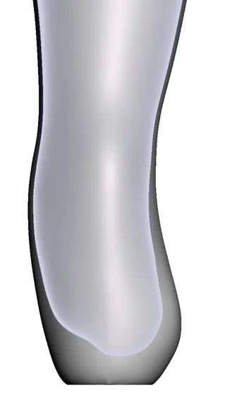 Exostosis — 3D model