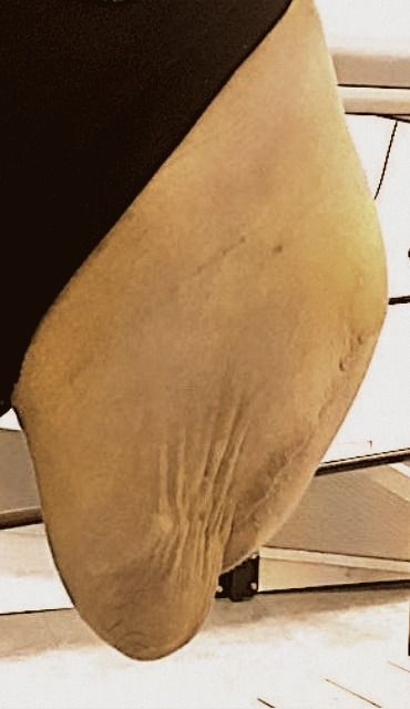 Conical/Pointy residual limb