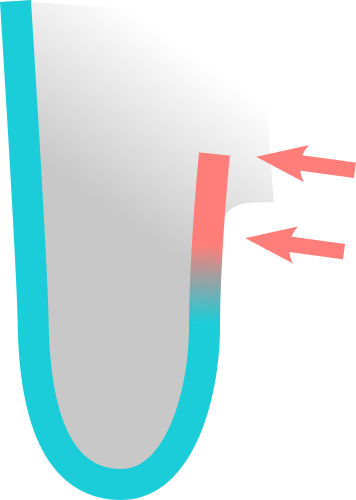 Excessive pressure on adductor tendon