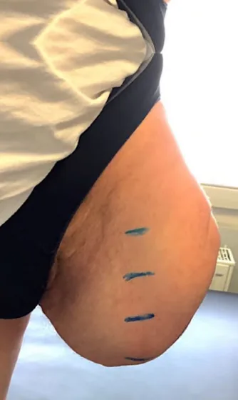 Short residual limb
