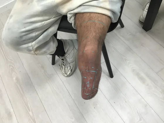 Bony residual limb