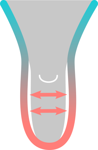 Standard liner too loose on distal section