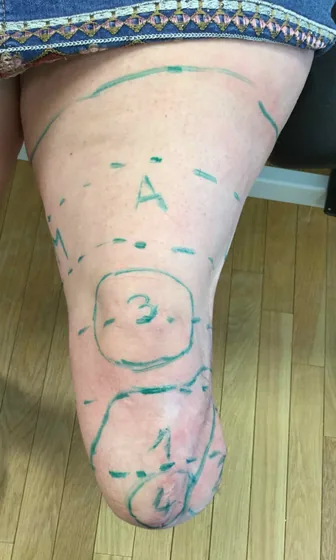 Conical Thigh — Limb