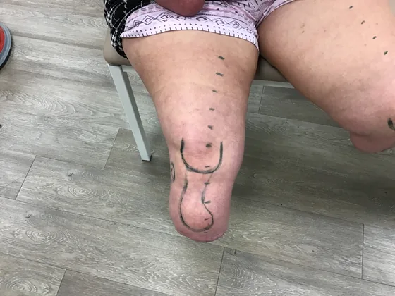 Conical Thigh residual limb