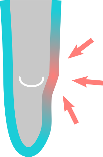 Standard liner overstretched on fibula