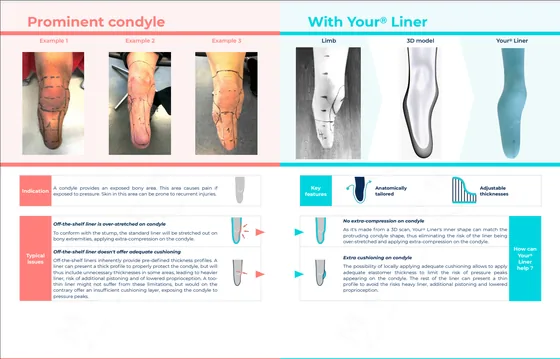 The prominent-condyle presentation