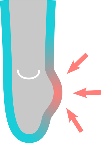 Standard liner overstretched on fibula