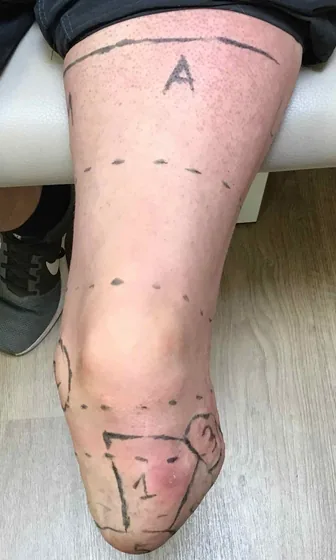 Prominent Fibula — Limb