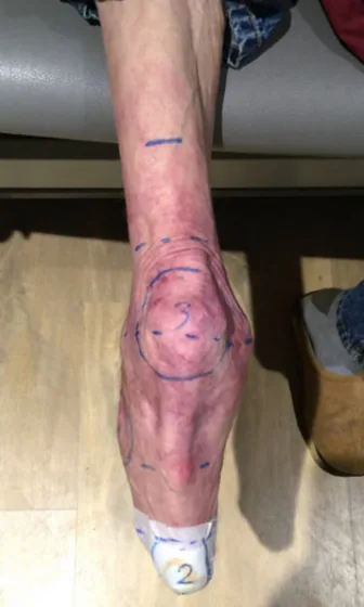 Thin Thigh — Limb