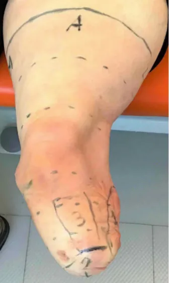 Varus/Valgus — Limb