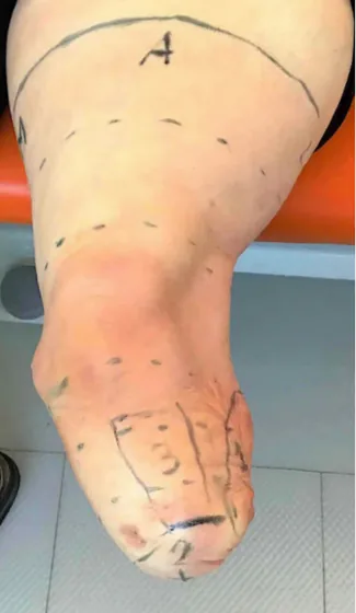 Varus/Valgus residual limb